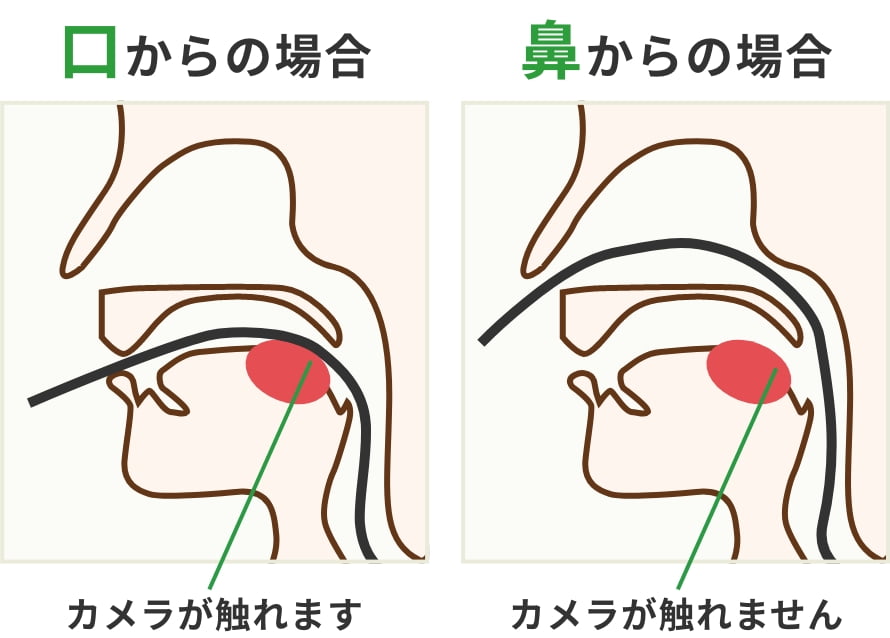 経口と経鼻の違い